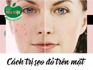 Cách trị sẹo đỏ trên mặt