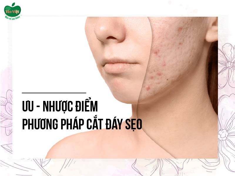 Ưu nhược điểm của phương pháp cắt đáy sẹo