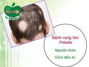 Bệnh rụng tóc Pelade