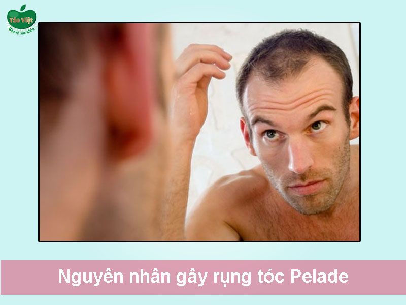 Nguyên nhân gây rụng tóc Pelade